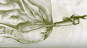 "Forceps.Smellie" by http://en.wikipedia.org/wiki/User:Ekem - http://en.wikipedia.org/wiki/Image:Forceps.Smellie.jpg. Licensed under Public domain via Wikimedia Commons - http://commons.wikimedia.org/wiki/File:Forceps.Smellie.jpg#mediaviewer/File:Forceps.Smellie.jpg